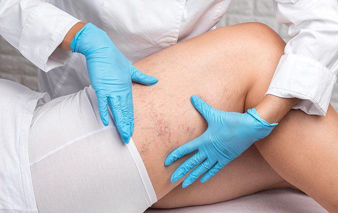 especialistas en varices