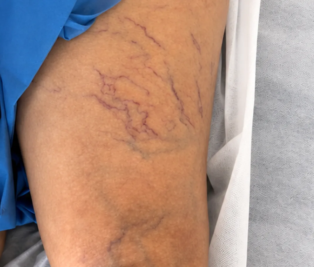 Antes de la escleroterapia: arañas vasculares en el muslo