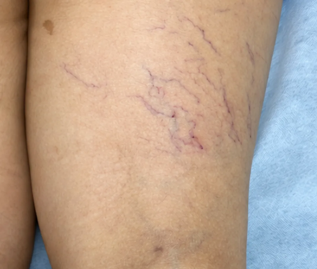 Después de la escleroterapia: el mismo muslo con menos arañas vasculares